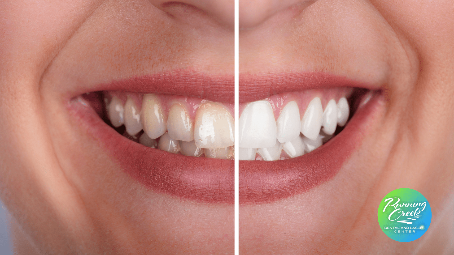 A before and after picture of a woman 's teeth.